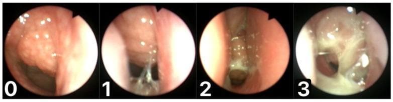 A series of four endoscopic clinical photographs of the nasopharynx demonstrating the Mucus of Adenoid Scale by Nasopharyngoscopy Assessment (MASNA). The images are labeled 0 through 3, illustrating a progressive increase in mucus volume and viscosity on the adenoid tissue. Scale 0 shows a normal, pink adenoid with no visible mucus. Scale 1 illustrates a mild residue of clear, watery, and transparent mucus. Scale 2 shows a moderate amount of dense, semi-opaque mucus accumulating on the surface. Scale 3 depicts copious, thick, dense, and opaque white-to-yellow mucus largely occluding the field of view and covering the adenoid. This comparison chart is used in Otolaryngology to standardize the evaluation of postnasal drip, rhinosinusitis, and adenoiditis. The educational focus is on distinguishing mucus characteristics—transparency, color, and thickness—to objectively score inflammatory status during diagnostic nasopharyngoscopy.