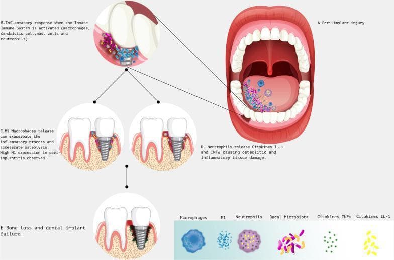 This medical infographic illustrates the pathophysiology and progression of peri-implantitis within the oral cavity. It features a central anatomical view of an open mouth showing microbiota distribution on the tongue and a localized peri-implant injury site. Surrounding diagrams detail the immune response and bone degradation sequence. Section B highlights the activation of the innate immune system, identifying macrophages, dendritic cells, mast cells, and neutrophils at the infection site. Inset C depicts M1 macrophage activity exacerbating inflammation and accelerating osteolysis. Inset D shows neutrophils releasing pro-inflammatory cytokines, specifically IL-1 and TNF-alpha, which drive osteolytic damage. The progression culminates in Section E, illustrating significant alveolar bone loss, gingival recession, and dental implant failure. A detailed legend identifies key components: Macrophages, M1 phenotype, Neutrophils, Buccal Microbiota, TNF-alpha, and IL-1. This educational diagram is intended for dental professionals and students to understand the host-microbe interactions leading to peri-implant tissue destruction.