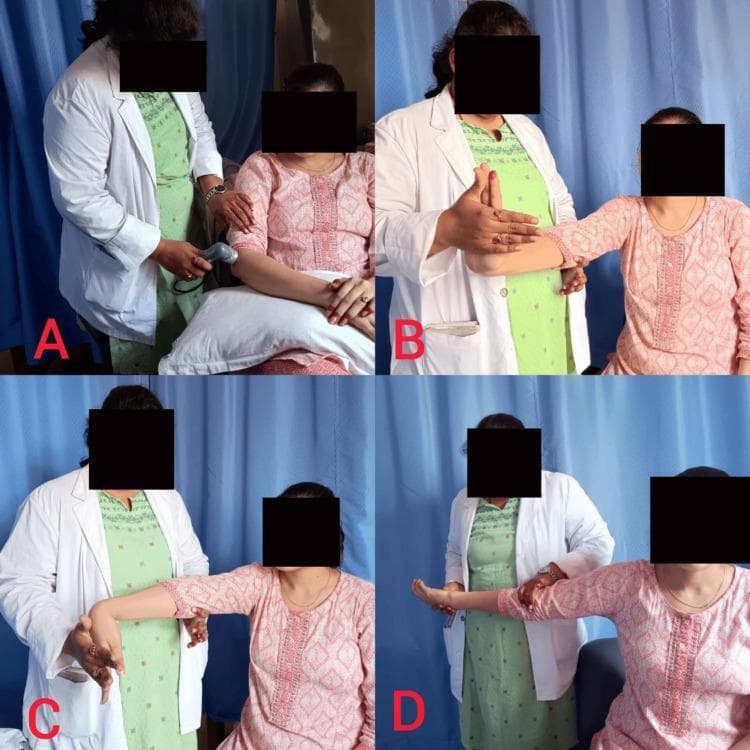 A composite of four clinical photographs (A-D) demonstrating therapeutic interventions for lateral epicondylitis (tennis elbow). Panel A shows the application of therapeutic ultrasound to the lateral aspect of the elbow joint with the arm rested on a pillow. Panels B and C illustrate passive stretching techniques: B shows the clinician extending the patient's wrist while the elbow is extended to stretch the forearm flexors, and C shows the clinician flexing the patient's wrist with the elbow extended to stretch the forearm extensors (common extensor origin). Panel D depicts the application of the Cyriax technique, a form of deep transverse friction massage combined with joint manipulation. In each panel, a clinician in a white coat performs the procedure on a seated patient. These images illustrate physical therapy modalities and manual therapy techniques used in a rehabilitation setting to manage musculoskeletal pain and improve range of motion.