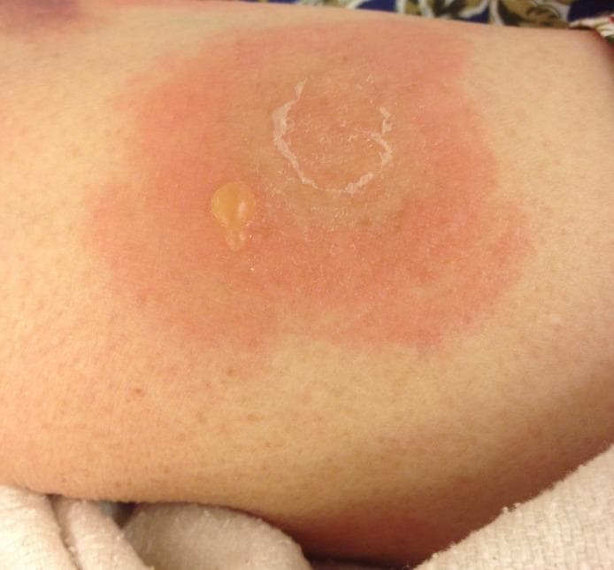 Clinical photograph of the left anterior thigh demonstrating dermatological findings characteristic of an autoimmune blistering disease, specifically bullous pemphigoid. The image shows a large, well-demarcated, circular erythematous and urticarial plaque approximately 5–7 cm in diameter. Centrally located on this inflammatory base is a small, intact, tense bulla containing serous, yellowish fluid. Adjacent to the intact blister is a larger area of epidermal denudation resulting from a ruptured bulla, characterized by a circular erosion with whitish, peripheral remnants of the detached blister roof (collarette of scale). The surrounding skin appears otherwise normal without evidence of scarring or active secondary infection. This visual presentation illustrates the typical clinical morphology of subepidermal blisters arising on an urticarial background, often associated with pruritus and eosinophilia in older adults.