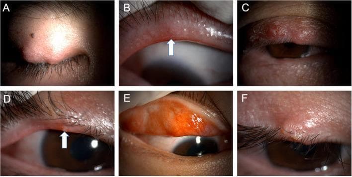 A composite of six clinical photographs (A-F) illustrating varying clinical presentations of recurrent or multiple chalaziosis on the eyelids. Panel A, C, and F show external views of localized, rounded, firm nodules within the tarsal plate of the upper eyelids, demonstrating typical chalazion morphology. Panel B (arrow) highlights telangiectasia and eyelid margin neovascularization, indicative of chronic blepharitis or meibomian gland dysfunction (MGD). Panel D (arrow) illustrates a lipid suppository or 'pouting' at a meibomian gland orifice, representing obstructed lipid secretions. Panel E shows an everted upper eyelid revealing significant palpebral conjunctival hyperemia and tarsal inflammation. Collectively, these images demonstrate the spectrum of meibomian gland-related eyelid pathology, including active granulomatous inflammation (chalazion), secondary vascular changes, and signs of underlying MGD, which are critical in the diagnosis of recurrent chalaziosis in ophthalmology and dermatology.