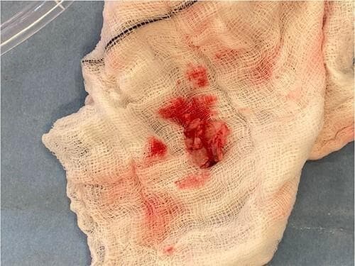 This intraoperative clinical photograph displays a macro-level view of excised cardiac vegetation, typical of infective endocarditis, resting on a white, sterile surgical gauze swab. The vegetation appears as an irregular, friable, and multi-lobulated tissue mass with a reddish-pink hue, indicating significant vascularization or associated blood clot formation. The specimen's texture is heterogeneous and rough, consistent with a collection of fibrin, platelets, and microorganisms typically found on heart valve surfaces during active infection. The surrounding white gauze shows several focal areas of bright red serosanguinous staining where the vegetation has been placed. This image is medically significant for illustrating the gross pathological morphology of a mitral valve vegetation following surgical excision and valve debridement. It serves as a visual record of the endovascular disease process, highlighting the size and friability of the mass that contributed to valvular regurgitation and potential embolic risk.