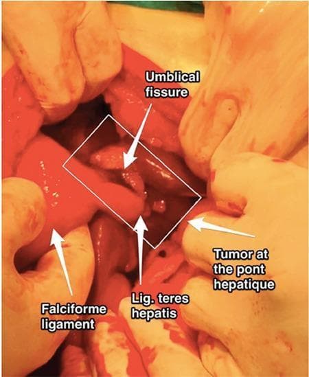 An intraoperative clinical photograph displaying an open abdominal surgical field focused on the liver and its supporting ligaments. The image features several anatomical landmarks and pathological findings labeled with arrows and a white bounding box. On the left, the falciform ligament is identified as it attaches to the liver surface. Centrally, within the white box, the umbilical fissure and the ligamentum teres hepatis (round ligament of the liver) are visible. To the right of these structures, a tumor implant is identified at the pont hépatique (hepatic bridge), appearing as an irregular, nodular tissue mass distinct from the surrounding smooth hepatic parenchyma. The tissues exhibit a glossy, reddish-pink appearance typical of live visceral organs during laparotomy. This image serves as a clinical example of hepatobiliary oncology and surgical anatomy, illustrating metastatic or primary tumor distribution within the hepatic fissures and along ligamentous attachments.