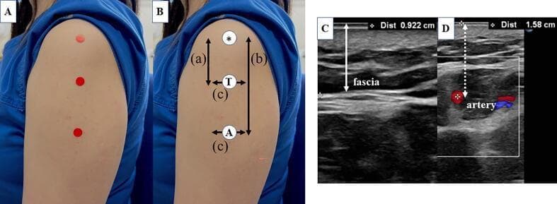 A multi-panel figure illustrating anatomical landmarks and ultrasound measurements for intramuscular vaccine injection sites in the deltoid muscle. Panels A and B are clinical photographs of a human arm showing three reference points: the mid-acromion lateral border (*), the three-finger breadth method injection point (T), and the axillary method injection point (A). Vertical and horizontal measurement lines (a, b, c) map the spatial relationships between the acromion and these injection sites. Panels C and D are corresponding B-mode and Doppler ultrasound images. Image C shows the subcutaneous layer and deltoid fascia, measuring a skin-to-fascia distance of 0.922 cm. Image D displays a Doppler ultrasound cross-section showing an adjacent artery (posterior circumflex humeral artery branch) with a measured skin-to-artery depth of 1.58 cm. The educational focus is on the safe depth of intramuscular injections to avoid vascular injury or Shoulder Injury Related to Vaccine Administration (SIRVA) by accurately locating anatomical landmarks and quantifying tissue thickness.
