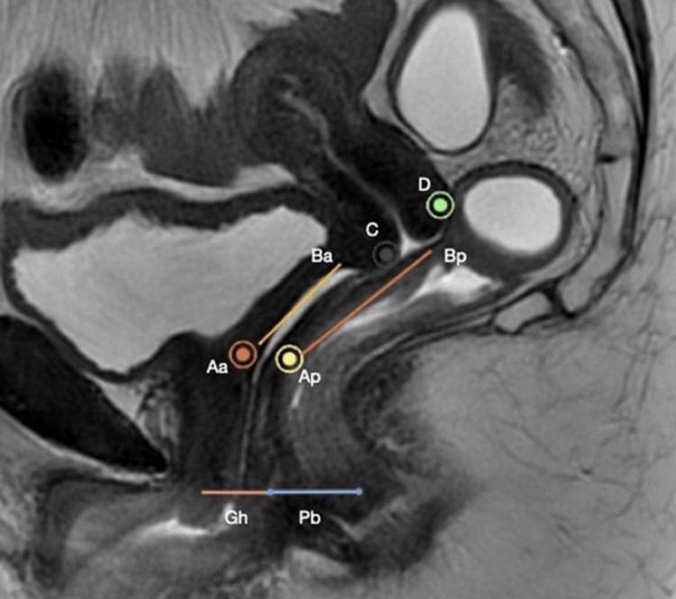 A mid-sagittal T2-weighted Magnetic Resonance Image (MRI) of the female pelvis, illustrating the anatomical landmarks used in the Pelvic Organ Prolapse Quantification (POP-Q) system. The image clearly depicts the uterus, a partially filled bladder, the vaginal canal, and the rectum. Superimposed on the anatomy are standardized POP-Q reference points: Aa and Ba (anterior vaginal wall), Ap and Bp (posterior vaginal wall), C (cervix/apex), and D (posterior fornix). Linear measurements at the pelvic outlet indicate the Genital Hiatus (Gh) and Perineal Body (Pb). Lines connect these points to demonstrate vaginal topography and relative descent. This diagnostic image serves as a clinical education tool for correlating radiological findings with physical examination stages of pelvic floor dysfunction, specifically identifying the relationship of pelvic organs to the plane of the hymen for prolapse assessment.