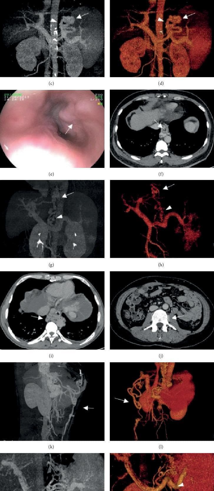 A multi-panel medical graphic illustrating gastroesophageal varices and portal hypertension using various imaging modalities. Panels (e) shows an endoscopic view of prominent esophageal varices. Panels (c, g, k) utilize contrast-enhanced Computed Tomography Maximum Intensity Projection (CT-MIP), while (d, h, l) utilize Volume Rendering (CT-VR) to provide a 3D visualization of the portal venous system. These reconstructions highlight gastric varices (arrows) originating from the short/posterior gastric veins (arrowheads), as well as a tortuous paraumbilical vein (panel k, l). Axial CT slices (i, j, f) identify specific collateral pathways, including paraesophageal and paravertebral varices appearing as rounded, hyperdense vascular structures adjacent to the esophagus and vertebral column. The composite image serves as a clinical comparison between invasive endoscopy and non-invasive Computed Tomography Portal Venography (CTPV) for assessing the severity and anatomy of portosystemic shunts.