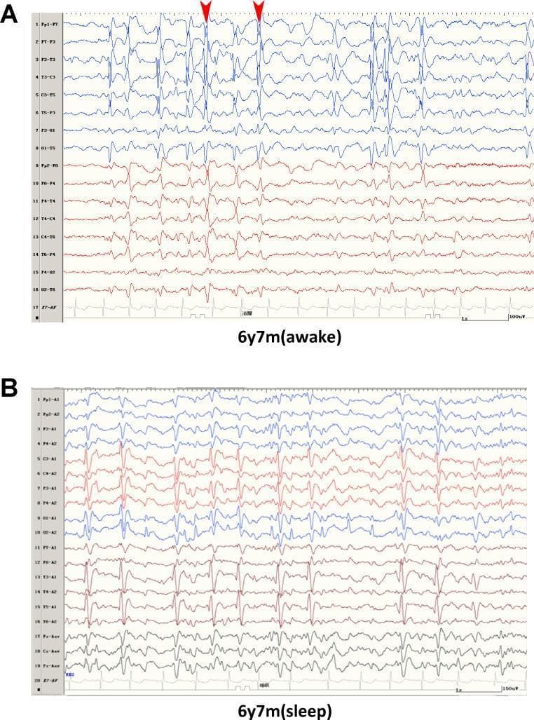 This diagnostic image displays a comparison of Electroencephalogram (EEG) recordings from a 6-year-old patient with focal epilepsy. Panel A illustrates the 'awake' state, showing irregular background activity characterized by frequent epileptiform discharges. Specifically, red arrowheads highlight spikes and spike-wave complexes concentrated in the Rolandic (centrotemporal) regions, with a more pronounced manifestation on the left hemisphere. Panel B depicts the 'sleep' state (NREM sleep), demonstrating a transition to slower, more synchronized background rhythms. In this state, the frequency of epileptiform activity increases significantly, with a discharge index of approximately 85%. The waveforms show high-amplitude, rhythmic spike-wave patterns across multiple channels, a hallmark of continuous spikes and waves during slow-wave sleep (CSWS) or related epileptic encephalopathies. The image serves as an educational tool for identifying Rolandic discharges and understanding the sleep-induced activation of epileptiform activity in pediatric focal epilepsy syndromes.