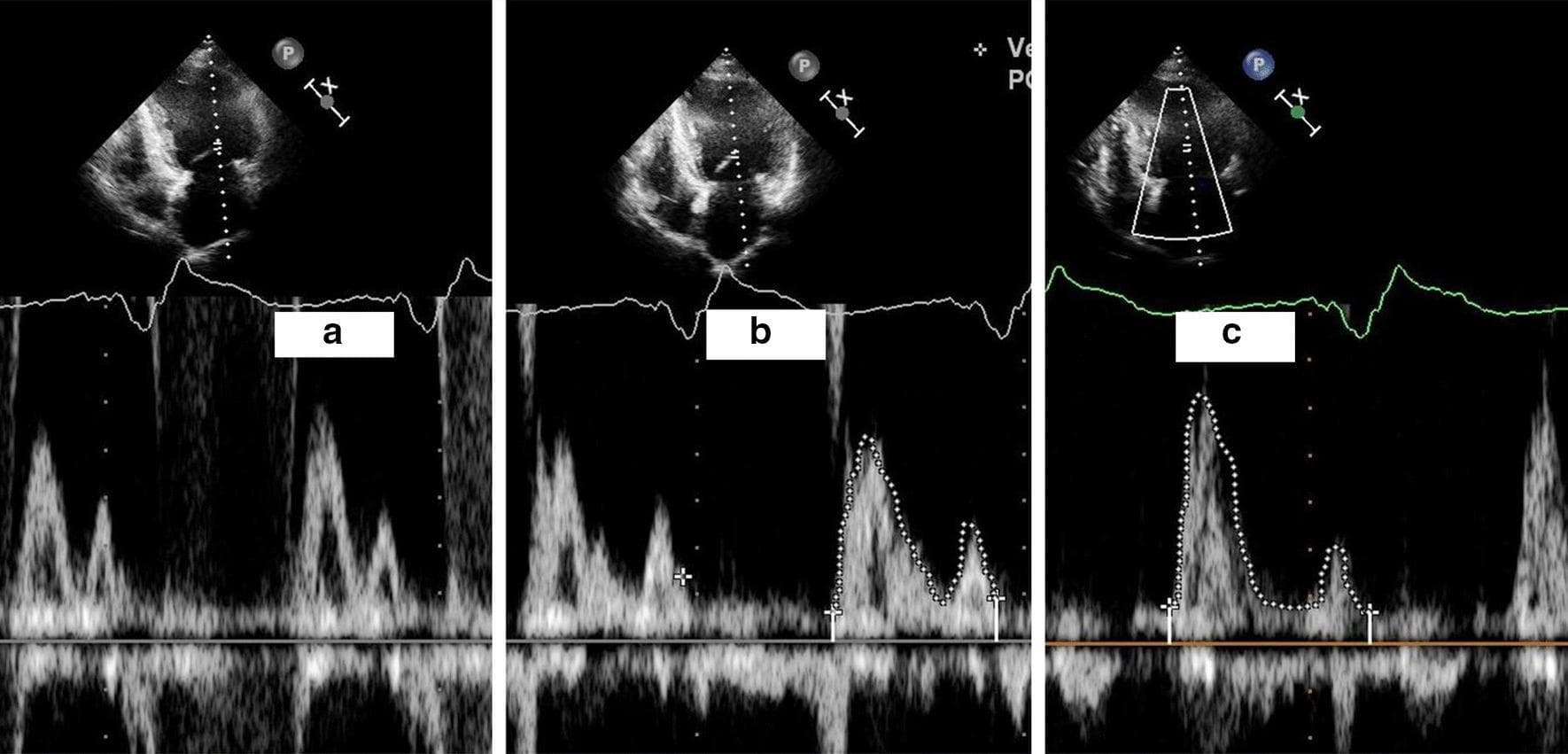 A comparison of three transthoracic echocardiography (TTE) panels demonstrating mitral inflow Doppler patterns in different cardiac pacing states. Each panel contains a grayscale apical four-chamber view (top) and a corresponding pulsed-wave Doppler recording (bottom) with concurrent electrocardiogram (ECG) tracing. Panel (a) shows atrioventricular (AV) desynchronization during VVI pacing, characterized by 'EA fusion' where the early diastolic (E-wave) and atrial contraction (A-wave) peaks are merged into a single broad envelope, indicating suboptimal ventricular filling. Panel (b) illustrates partial separation of E and A waves during intermittent intrinsic ventricular deflections. Panel (c) demonstrates restored AV synchrony during DDD pacing mode after new atrial lead implantation; the Doppler recording shows distinct, separated E and A wave peaks (outlined in white), representing physiological diastolic filling. This visual comparison highlights the impact of pacemaker programming and lead placement on left ventricular hemodynamics and diastolic performance in patients with AV desynchronization.