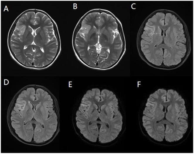 This diagnostic imaging panel consists of axial brain MRI slices from a pediatric patient, demonstrating radiological findings associated with anti-NMDA receptor encephalitis. The panel includes three sequences: T2-weighted imaging (A, B), Fluid-Attenuated Inversion Recovery (FLAIR) (C, D), and Diffusion-Weighted Imaging (DWI) (E, F). The images reveal significant hyperintense (high signal) abnormalities localized to the right temporal lobe, insula, and frontal cingulate gyrus. These lesions exhibit a characteristic lamellar morphology along the cortical and subcortical regions. T2WI (A, B) shows increased signal intensity indicative of vasogenic edema or inflammation. FLAIR images (C, D) highlight these same regions by suppressing cerebrospinal fluid signal, emphasizing the cortical involvement. DWI scans (E, F) demonstrate restricted diffusion within the affected areas, suggesting acute inflammatory cytotoxic changes. These multi-sequence findings are key diagnostic indicators for autoimmune encephalitis in clinical settings, particularly when presenting with pediatric convulsions and anti-NMDAR antibody positivity.