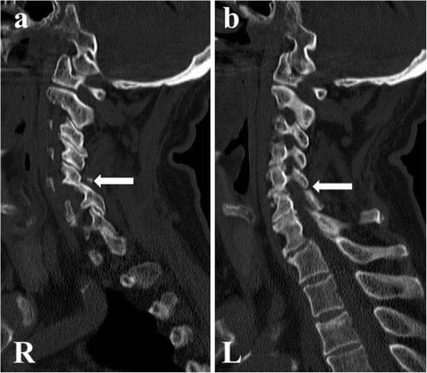 This diagnostic image consists of two sagittal computed tomography (CT) scans of the human cervical spine, bone window, labeled (a) 'R' for the right side and (b) 'L' for the left side. The images demonstrate the cervical vertebrae from the skull base down to the upper thoracic region. The primary pathology is a bilateral facet joint dislocation at the C5-C6 level, indicated by white horizontal arrows in both panels. This finding represents a significant post-traumatic cervical spine injury characterized by the displacement of the inferior articular processes of C5 anterior to the superior articular processes of C6, resulting in vertebral malalignment and disruption of the normal posterior spinal curvature. The vertebral bodies at other levels maintain a generally rectangular shape with preserved intervertebral disc spaces. This visual serves as a critical educational example of high-grade spinal instability and segmental dislocation following cervical trauma, highlighting the importance of sagittal reconstruction in identifying facet joint 'jump' or lock.