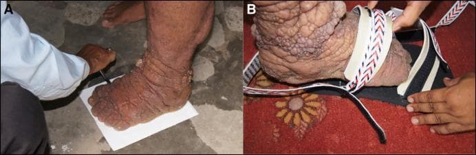 A two-part clinical photograph illustrating the management of advanced stage lymphatic filariasis (elephantiasis) and associated lymphedema. Image A displays a patient's lower leg and foot, demonstrating severe non-pitting edema with marked skin thickening (pachyderma) and deep transverse folds. The skin surface is rough and hyperkeratotic, featuring multiple nodular and verrucous (wart-like) lesions characteristic of mossy foot or podoconiosis. A healthcare provider is shown tracing the foot's enlarged outline for custom footwear. Image B shows the application of a specialized, adaptable shoe. The shoe features a thick, reinforced sole and wide, adjustable Velcro straps with a chevron pattern designed to accommodate extreme swelling and anatomical distortion while providing protection. These images illustrate key components of morbidity management and disability prevention (MMDP) in filariasis-endemic regions, emphasizing the importance of tailored footwear to prevent secondary bacterial and fungal infections and improve patient mobility.