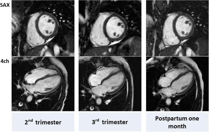 This diagnostic image displays a series of Cine Cardiovascular Magnetic Resonance (CMR) scans from a representative pregnant woman, organized to compare cardiac structure across three time points: 2nd trimester, 3rd trimester, and one month postpartum. The top row presents the short-axis (SAX) view at the mid-ventricular level, while the bottom row shows the horizontal long-axis (4-chamber) view. The images illustrate physiological cardiac remodeling during pregnancy. Key observations include a visible increase in left ventricular (LV) mass and end-diastolic volume during the 3rd trimester compared to the postpartum baseline. In the SAX view, the LV myocardium appears slightly thicker in the 3rd trimester, while the 4-chamber view demonstrates the maintenance of normal ventricular geometry and relationship between the LV and right ventricle (RV). These images serve as educational materials for understanding the reversible eccentric hypertrophy and volume expansion that characterize healthy maternal cardiovascular adaptation to pregnancy.
