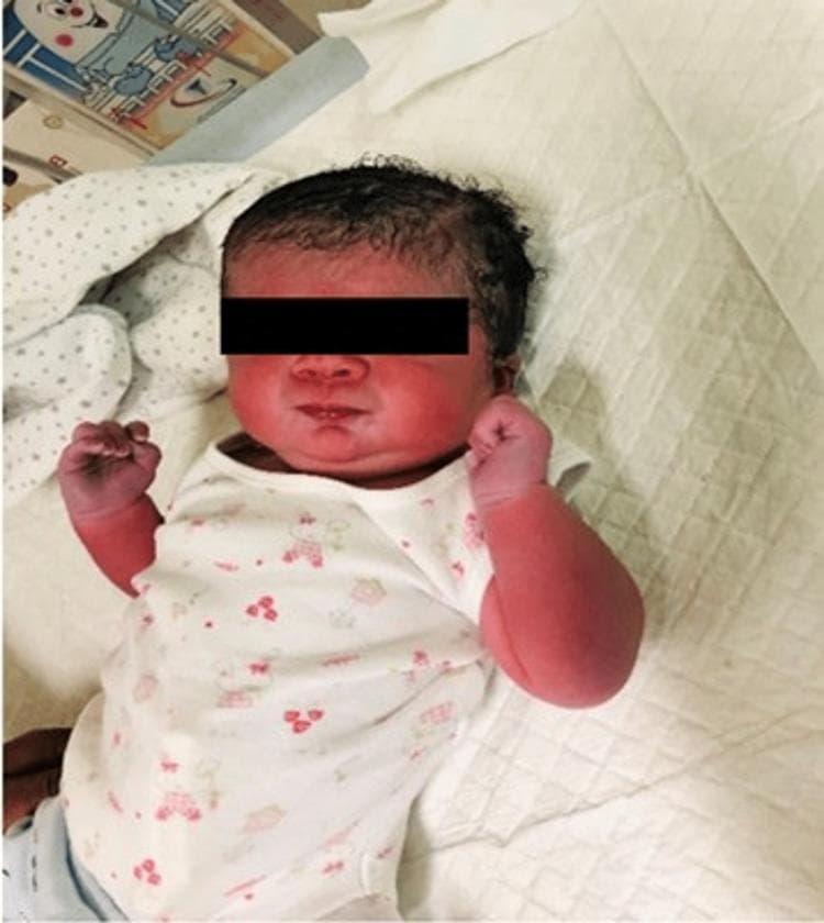 Clinical photograph of a late preterm newborn infant following delivery. The image shows a macrosomic infant (birth weight 3.9 kg) with a prominent reddish hue (plethora) visible on the face, arms, and hands. The infant has dark, thick, curly scalp hair and is shown in a supine position with hands clenched. The facial profile does not exhibit overt dysmorphic features. The clinical context involves an infant of a diabetic mother (IDM), born via cesarean delivery, who subsequently developed complications including respiratory distress, hypocalcemia, and hypoglycemia. This visual serves as an educational example of a newborn affected by gestational diabetes, illustrating the physical appearance of macrosomia and cutaneous plethora without specific congenital anomalies or dysmorphic features.