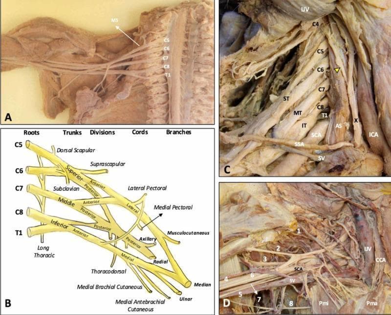 This composite educational graphic details the anatomy of the human brachial plexus (BP) through cadaveric dissections and a schematic diagram. (A) Cadaveric dissection of the cervical spine and axilla with the anterior scalene muscle removed, exposing the C5-T1 nerve roots emerging laterally to the middle scalene muscle (MS). (B) A structured schematic diagram illustrating the hierarchical organization of the BP from roots (C5-T1), trunks (Superior, Middle, Inferior), divisions (Anterior, Posterior), and cords (Lateral, Posterior, Medial) to terminal branches. (C) Dissection showing the roots in situ within the scalene triangle, formed between the anterior (AS) and middle scalene muscles, alongside major vessels including the subclavian artery (SCA) and internal jugular vein (IJV). The phrenic nerve (yellow arrowhead) is seen traversing the anterior scalene. (D) Detailed view of the infraclavicular and axillary regions showing terminal branches (1-8: suprascapular, musculocutaneous, axillary, radial, medial brachial cutaneous, median, ulnar, and intercostobrachial nerves) in relationship to the pectoralis minor (Pmi), pectoralis major (Pma), and subclavian vessels. This content provides essential topographical and clinical anatomy for understanding thoracic outlet syndrome and regional anesthesia.