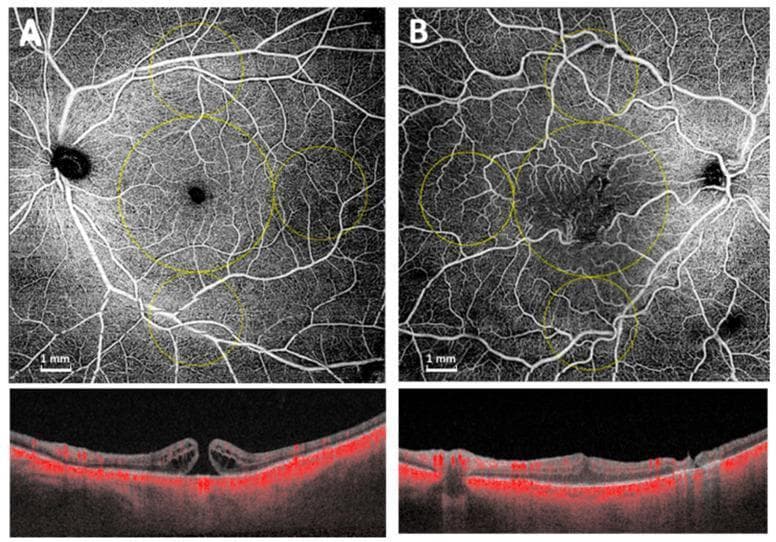 Educational diagnostic comparison using widefield Optical Coherence Tomography Angiography (OCTA) and structural OCT to distinguish between a full-thickness macular hole (MH) and an epiretinal membrane (ERM). Panel A displays a 12x12 mm OCTA scan of the superficial capillary plexus (SCP) in a patient with a macular hole, showing an enlarged foveal avascular zone (FAZ) and rarefied macular capillary density. The corresponding structural B-scan shows a full-thickness foveal defect with intraretinal cystic changes and elevated edges. Panel B displays an OCTA scan of an ERM, showing a more preserved FAZ but with tortuous vascular patterns. The corresponding structural B-scan reveals a hyperreflective band on the inner retinal surface causing tractional distortion and inner retinal thickening. Yellow circular overlays indicate the standardized 5 mm macular annulus and 3 mm mid-peripheral regions used for quantitative vascular analysis. This content is designed for intermediate to advanced ophthalmology education, focusing on vitreoretinal pathology and advanced imaging interpretation.