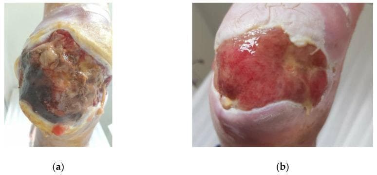 Clinical photograph of a diabetic foot ulcer on the heel, showing a comparison of wound healing over 33 days. Panel (a) illustrates the baseline (Day 0) state, characterized by a large, deep ulcer with significant necrotic tissue, dark eschar in the lower wound bed, and greenish-yellow slough indicative of Pseudomonas aeruginosa infection. The wound margins are irregular with surrounding erythema. Panel (b) shows the same wound on Day 33 after topical medical grade honey treatment. There is a marked reduction in total wound surface area. The wound bed has transitioned to healthy, beefy red granulation tissue with no visible necrosis or slough. Evidence of epithelialization is visible at the wound edges, and the surrounding skin appears less inflamed and macerated. The image sequence demonstrates the progression from a chronic, infected Stage B, Grade 3 diabetic ulcer to a vital, granulating wound bed suitable for continued secondary intention healing.