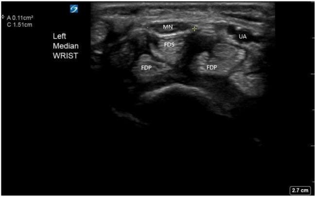 Diagnostic ultrasound image of the left wrist in a transverse cross-section, demonstrating the carpal tunnel anatomy for the evaluation of carpal tunnel syndrome. The median nerve (MN) is identified as a superficial hypoechoic, honeycomb-textured structure superior to the flexor digitorum superficialis (FDS) and flexor digitorum profundus (FDP) muscle tendons. To the lateral aspect, the ulnar artery (UA) is visible as an anechoic circular structure. A caliper-based measurement tool outlines the circumference of the median nerve, showing a cross-sectional area (CSA) of 0.11 cm² and a circumference of 1.51 cm. This imaging modality is used clinically to assess for median nerve enlargement, a hallmark of entrapment neuropathy. The anatomical relationship between the nerve and the underlying flexor tendons is clearly labeled, providing context for diagnostic assessment or ultrasound-guided regional anesthesia such as a nerve block.