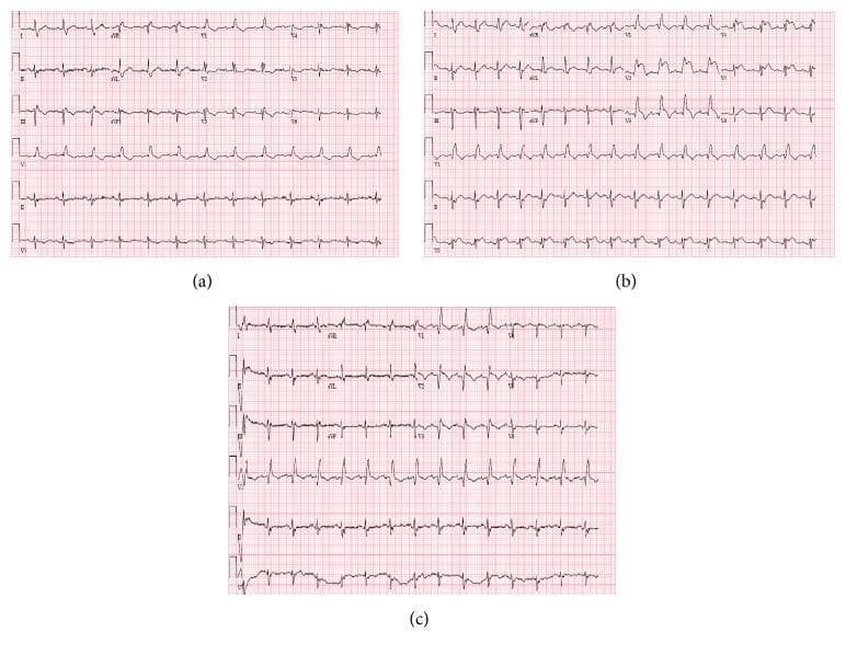 A series of three 12-lead electrocardiograms (ECGs) labeled (a), (b), and (c) demonstrating the progression and resolution of an ST-elevation myocardial infarction (STEMI). Panel (a) shows the baseline ECG with a right bundle branch block (RBBB), characterized by an RSR' pattern in lead V1 and widened QRS complexes. Panel (b) illustrates acute changes with significant ST-segment elevation in the anterior precordial leads (V2–V5) and hyperacute, peaked T waves, indicating an acute anterior wall myocardial infarction, likely due to left anterior descending (LAD) artery occlusion. Panel (c) shows the post-intervention ECG following coronary revascularization, demonstrating the resolution of the ST-segment elevation and a return toward the baseline RBBB morphology. The images provide a comparison of ischemic evolution, highlighting the dynamic nature of ST-T segment changes in clinical cardiology.
