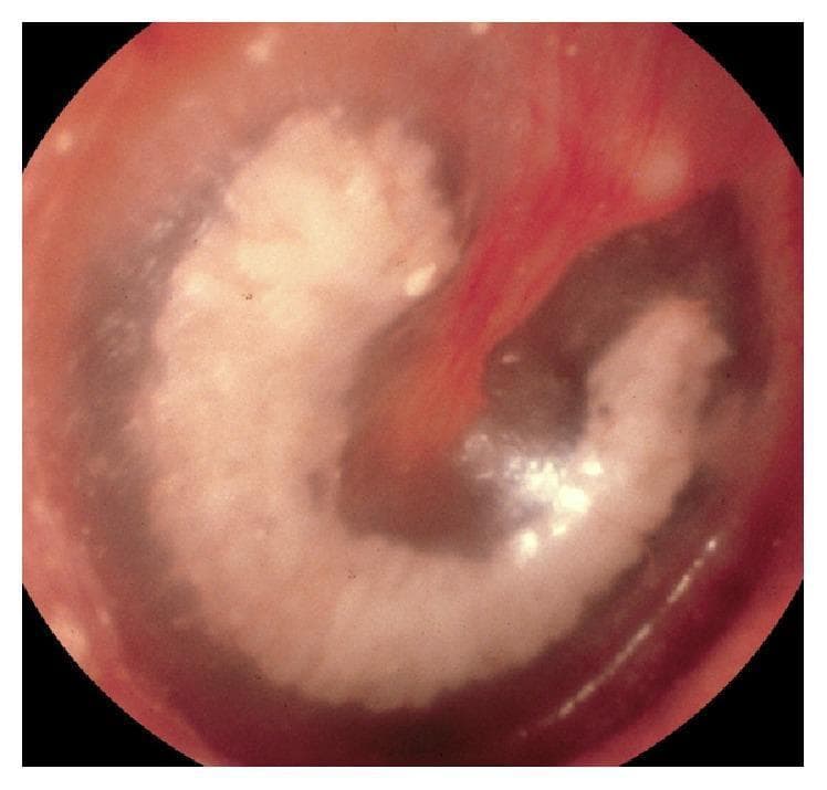 This clinical photograph shows an endoscopic view of a right tympanic membrane demonstrating significant tympanosclerosis. The primary finding is a dense, chalky white, semi-circular plaque within the substance of the eardrum. This sclerotic lesion is prominent in the pars tensa and extends superiorly to involve the pars flaccida. The plaque partially surrounds and obscures the proximal portion of the malleus manubrium, which appears hyperemic (reddened). The remaining portions of the tympanic membrane appear diffusely thickened and opaque, though the middle ear space remains aerated without signs of active effusion or infection. This visual represents the hyalinization and calcification of the fibrous layer of the tympanic membrane, a common sequela of chronic otitis media or previous ventilation tube insertion, which can lead to conductive hearing loss by reducing membrane compliance.