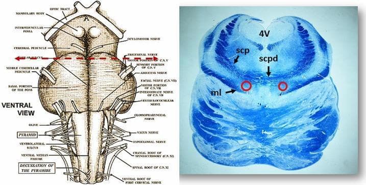Educational medical graphic showing the neuroanatomy of the human brainstem. On the left is a labeled anatomical diagram of the ventral brainstem, including the optic tract, mammillary bodies, pons, and medulla oblongata, with a red dashed line indicating the level of a transverse section through the rostral pons. On the right is a corresponding histological image of the rostral pons using KlΓΌver-Barrera staining. The blue luxol fast blue stain highlights myelinated fiber tracts such as the superior cerebellar peduncles (scp) and the medial lemniscus (ml). Key labeled structures include the fourth ventricle (4V) dorsally and the decussation of the superior cerebellar peduncles (scpd) in the midline. Red circles identify the bilateral localization of the KΓΆlliker-Fuse nucleus (KFN), situated between the scpd and ml. This visual resource is used to teach the spatial relationships of brainstem nuclei and fiber tracts within the respiratory control centers of the rostral pons.