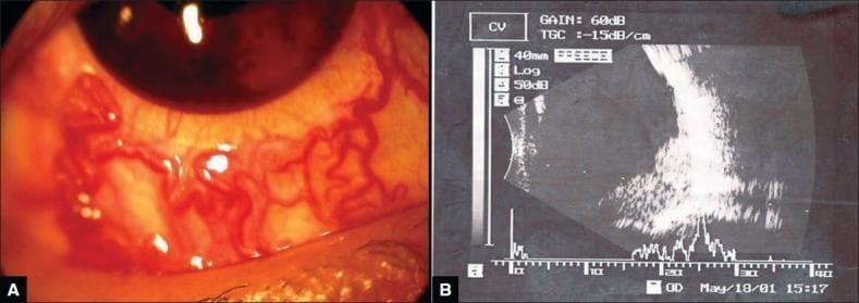 Educational medical visual presenting ocular manifestations of Von Hippel-Lindau (VHL) disease. Panel A is a clinical photograph of the right eye demonstrating significant racemose dilatation and tortuosity of the bulbar conjunctival blood vessels. A cosmetic contact lens is visible over the cornea. Panel B is a B-scan ocular ultrasonography (USG) displaying a large, hyperechoic mass lesion originating from the posterior pole. The mass is localized primarily in the inferior and infero-temporal quadrants, obscuring the optic disc and macula. The imaging illustrates complications associated with bilateral angiomatous retinal lesions, including potential secondary closed-angle glaucoma and posterior segment tumor extension. This material is suitable for ophthalmology students and residents focusing on retinal hemangioblastomas and their secondary clinical effects on ocular surface and internal structures.