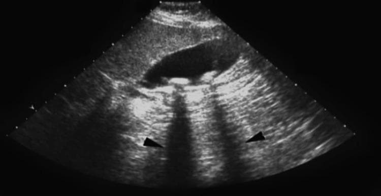 This abdominal ultrasound image displays a diagnostic view of the gallbladder containing cholelithiasis (gallstones). The gallbladder appears as a prominent, elongated, anechoic (black) sac-like structure. Inside the lumen, multiple hyperechoic (bright) foci are visible along the dependent wall, representing gallstones. Crucially, the image demonstrates the classic diagnostic sign of posterior acoustic shadowing, where dark, vertical hypoechoic bands extend inferiorly from the stones, indicated by black arrowheads. This phenomenon occurs as the dense stones attenuate the ultrasound beam, preventing sound waves from reaching deeper tissues. The surrounding liver parenchyma shows a normal, homogeneous intermediate echogenicity. This visual is typical for diagnosing symptomatic or asymptomatic gallstone disease in a clinical or preoperative setting.