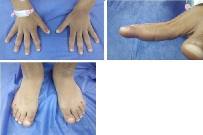 Clinical photograph composite demonstrating severe digital clubbing (Hippocratic fingers) of the hands and feet. The top left and bottom panels provide dorsal views of the bilateral hands and feet, showing significant bulbous enlargement of the distal phalanges. The fingertips and toes exhibit a characteristic 'drumstick' appearance with widening and hypertrophy of the soft tissue at the terminal ends. The top right panel displays a lateral profile view of a single finger, clearly illustrating the loss of the normal Lovibond angle (the angle between the nail base and the adjacent skin fold) and an increased longitudinal convexity of the nail bed. These visual findings are classic clinical indicators of chronic hypoxia, cyanotic heart disease, pulmonary disorders, or systemic conditions such as pachydermoperiostosis. The image serves as a high-quality educational resource for identifying grade 4 digital clubbing during a physical examination.