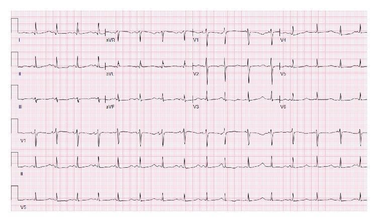 A standard 12-lead electrocardiogram (ECG) demonstrating a sinus rhythm with a significantly prolonged QT interval. The QTc is calculated at 632 ms, which represents a high risk for the development of Torsades de Pointes. The T waves are notably broad and prominent across most leads, appearing upright in leads I, II, aVF, and V2-V6, while inverted in lead aVR. The QRS complexes maintain a normal duration and morphology with appropriate R-wave progression in the precordial leads (V1 to V6), showing no signs of bundle branch blocks or acute ST-segment elevation. This diagnostic image serves as a clinical example of severe drug-induced or electrolyte-related QT prolongation, commonly associated with conditions like hypokalemia or hypomagnesemia in a clinical setting. The visual illustrates the critical importance of interval measurement in ECG analysis for identifying life-threatening arrhythmia risks.