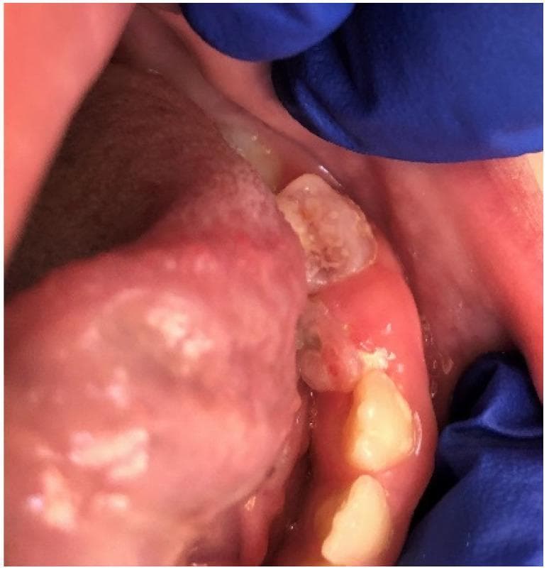 This clinical photograph displays a pyogenic granuloma in the oral cavity of a pediatric patient, specifically located on the gingiva adjacent to deciduous teeth 74 and 75. The lesion presents as a smooth, elevated, and sessile mass characterized by a broad base of attachment. The surface of the growth exhibits a pink-to-reddish hue, which is characteristic of highly vascularized reactive inflammatory tissue. The surrounding gingival tissue shows clinical signs of localized inflammation, including erythema and swelling, with a loss of the normal stippled texture. The teeth in the immediate vicinity appear to have significant dental plaque and debris, suggesting poor oral hygiene as a likely precipitating factor for this reactive hyperplasia. The image illustrates the typical appearance of a non-neoplastic, hyperplastic lesion often occurring in response to chronic low-grade irritation or trauma. This material is useful for dental and oral pathology education regarding the differential diagnosis of localized gingival enlargements.