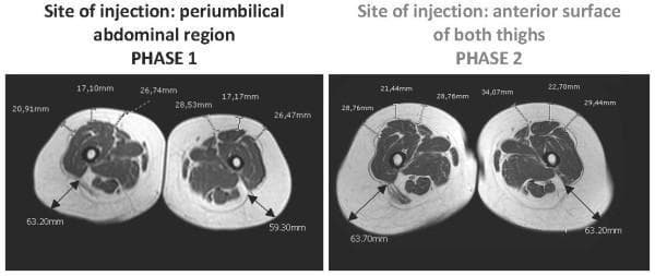 This diagnostic image consists of axial T1-weighted MRI cross-sections of the bilateral thighs, illustrating medication-induced lipohypertrophy. The image is divided into two comparative panels: Phase 1 (injection site: abdomen) and Phase 2 (injection site: anterior thighs), demonstrating the local adipose tissue response to Pegvisomant therapy. Quantitative annotations show measurements of subcutaneous fat thickness and overall thigh circumference. In Phase 1, subcutaneous fat thickness ranges from 17.10 mm to 28.53 mm. In Phase 2, following the change of the injection site to the thighs, there is a visible and measurable increase in subcutaneous fat, with values reaching up to 34.07 mm. Total thigh circumference also demonstrates an increase, with Phase 2 measurements (63.20 mm - 63.70 mm) exceeding those in Phase 1 (59.30 mm - 63.20 mm). The central muscle mass and femoral cortical bone remain largely unchanged, emphasizing that the hypertrophy is localized to the subcutaneous adipose layer. This comparison illustrates the reversibility and site-specific recurrence of lipohypertrophy associated with growth hormone receptor antagonist injections.