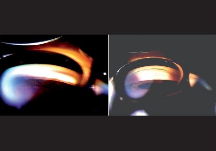 This diagnostic image consists of two side-by-side clinical photographs showing gonioscopy of the anterior chamber angle of the eye under different lighting conditions. The left panel demonstrates the angle with bright illumination and a long slit beam. This lighting causes miosis (pupil constriction), which visually pulls the iris away from the trabecular meshwork, creating the appearance of an open angle. A prominent bright white and orange light reflex is visible across the iris and cornea. The right panel demonstrates the same anterior chamber angle under dim illumination. In these appropriate testing conditions, the lack of light stimulus prevents pupillary constriction, revealing the true state of the angle, which appears closed or significantly narrowed as the iris root approximates the corneal endothelium. The comparison illustrates the clinical importance of controlling ambient light during gonioscopy to avoid false-negative results in angle-closure glaucoma screening.