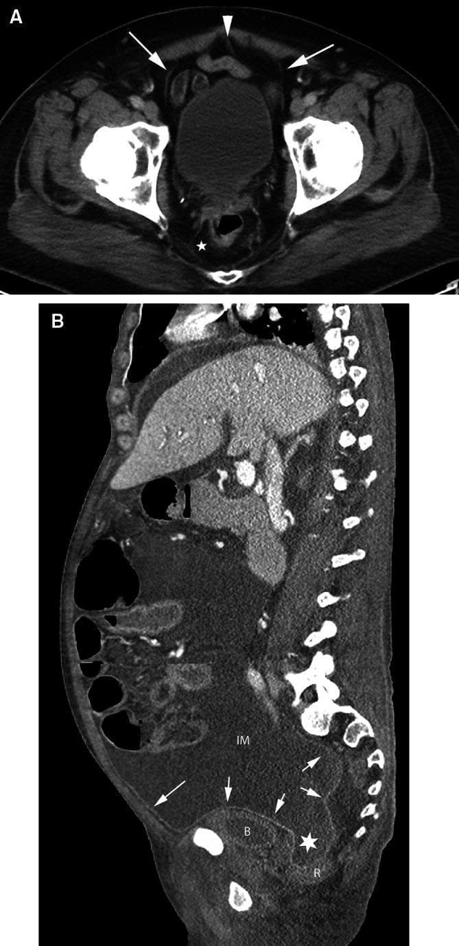 This educational clinical imaging figure consists of two CT scans (axial and sagittal) demonstrating the anatomy of pelvic spaces and peritoneal reflections. Image A is an axial CT scan of the pelvis at the level of the urinary bladder. An arrowhead identifies the urachus (median umbilical ligament), and arrows point to the obliterated umbilical arteries (medial umbilical folds). These structures are encased within the umbilicovesical fascia, defining the perivesical space. The prevesical space is visible anterior and lateral to the bladder, while a star indicates the perirectal space. Image B is a sagittal CT scan showing the course of the peritoneum (arrows) along the anterior abdominal wall as it reflects over the bladder (B) and rectum (R). The image illustrates a large volume of peritoneal fluid in the inframesocolic compartment (IM) communicating with the rectovesical recess (star). The bladder is seen displaced inferiorly by the fluid. This material is designed to teach the distinction between intraperitoneal and subperitoneal spaces, crucial for understanding pathways of disease spread in the pelvis.