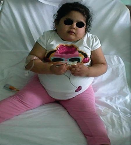 This clinical photograph shows a 5-year-old female patient presenting with severe early-onset childhood obesity. The patient exhibits a high body mass index (BMI), characterized by significant truncal adiposity and excess soft tissue in the facial and proximal limb regions. She is seated on a clinical examination bed, and an intravenous (IV) catheter is visible on her right distal forearm, indicating active medical management. The patient has dark curly hair and is shown in a frontal view. Clinically, this presentation is associated with complex endocrine and autonomic dysregulation, including secondary adrenal insufficiency, central hypothyroidism, and autonomic dysfunction. The visual evidence of rapid weight gain in early childhood is a key diagnostic indicator for evaluating genetic obesity syndromes or hypothalamic-pituitary disorders. The photograph serves as a clinical example of the physical manifestations associated with multi-system endocrine failure and pulmonary hypertension in a pediatric setting.