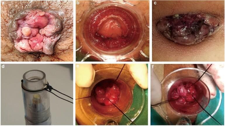 This composite of clinical photographs and procedural frames documents the pathology and surgical management of prolapsed hemorrhoids. Panels (a) and (c) present external views of perianal pathology: (a) shows grade IV prolapsed internal hemorrhoids with characteristic pink, fleshy, nodular protrusions; (c) demonstrates strangulated or thrombosed hemorrhoidal tissue, indicated by a dark purple to black discoloration and significant venous congestion. Panels (b), (e), and (f) depict an intraoperative view using a clear anoscope/proctoscope. These frames illustrate a surgical ligation or mucopexy technique where black suture threads are used to secure and retract the redundant hemorrhoidal mucosa. Panel (d) displays the specialized clear cylindrical surgical instrument used to facilitate the procedure. The series serves as an educational resource for coloproctology, highlighting the clinical presentation of advanced hemorrhoidal disease and the steps of a minimally invasive interventional approach to reduce prolapse and restore anatomical positioning.