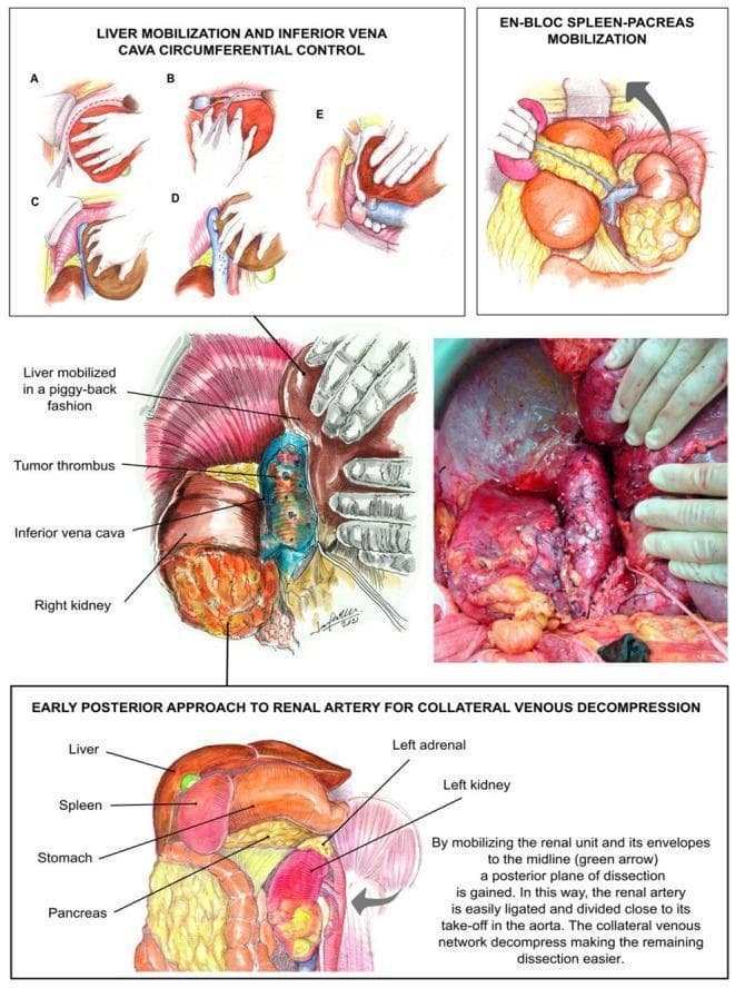 A multi-panel medical illustration and clinical photograph detailing the transplant-based surgical approach for radical nephroureterectomy with tumor thrombectomy. The upper panels (A–E) demonstrate liver mobilization steps: division of left and right triangular ligaments, division of the coronary ligament, rolling the right hepatic lobe to the midline, 'piggy-back' dissection of short hepatic veins, and circumferential control of the infrahepatic/retrohepatic inferior vena cava (IVC). A central anatomical diagram and corresponding intraoperative clinical photograph show a right kidney with a level IIIa tumor thrombus extending into the IVC. The lower section illustrates 'En-bloc spleen-pancreas mobilization' and the 'early posterior approach to the renal artery,' showing the medial displacement of the renal unit (green arrow) to facilitate ligation of the renal artery near the aorta. This technique aims to decompress collateral venous networks and provide exposure of the retroperitoneal space for oncological resection.