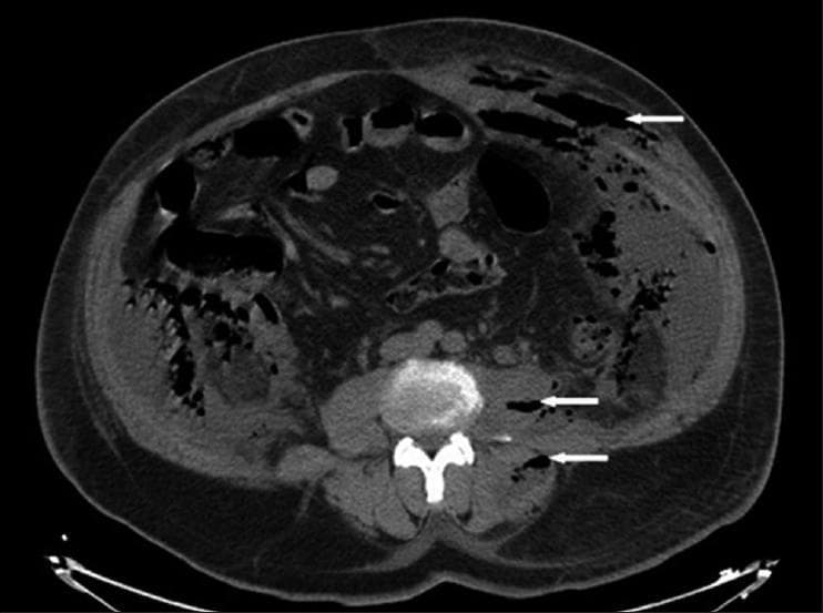 This diagnostic axial computed tomography (CT) scan of the lower abdomen and retroperitoneum demonstrates extensive scattered gas collections (indicated by white arrows) characteristic of necrotizing fasciitis. The hypodense (dark) gas pockets are visible within multiple anatomical compartments, including the left psoas muscle, latero-vertebral muscles, and the fascial planes. Significant subcutaneous emphysema is also noted in the lower abdominal wall. The gas appears to dissect through muscle layers and fascial boundaries, causing architectural distortion and tissue separation. These findings are clinically significant as they indicate a fulminant soft-tissue infection or retroperitoneal-necrotizing fasciitis, often secondary to intra-abdominal or urological suppuration like pyonephrosis. The presence of gas along the retroperitoneal structures and abdominal wall highlights the invasive nature of the disease and serves as a critical radiological marker for urgent surgical debridement.