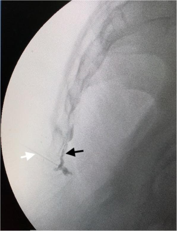 This diagnostic image is a lateral fluoroscopic view of the sacrococcygeal region, demonstrating the procedure for an impar ganglion block. The image shows the bony anatomy of the distal sacrum and coccyx. A thin, radiopaque 22-gauge needle is visible (indicated by a white arrow) inserted through the sacrococcygeal junction. The needle tip is positioned in the retrorectal space, immediately anterior to the sacrococcygeal joint. A dark, radiopaque contrast agent (indicated by a black arrow) is seen spreading along the anterior aspect of the coccyx, forming a characteristic 'comma' shape that confirms the correct retroperitoneal placement of the needle for the sympathetic block. This procedure is clinically relevant for managing chronic perineal or pelvic pain. The image serves as an educational example of real-time imaging guidance for precise interventional pain management in anesthesiology and radiology.