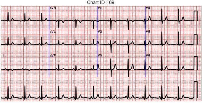 This diagnostic image shows a standard 12-lead electrocardiogram (ECG) displayed on a red-ruled grid. The chart is organized into four rows: the top three rows represent the standard limb leads (I, II, III), augmented limb leads (aVR, aVL, aVF), and precordial leads (V1–V6) in a three-channel format, while the bottom row provides a continuous rhythm strip of Lead II. Each lead demonstrates clear P waves, narrow QRS complexes, and T waves, indicating a normal sinus rhythm. The grid follows standard calibration where the vertical axis represents voltage (10 mm = 1 mV) and the horizontal axis represents time (25 mm = 1 s). Notable morphology includes normal R-wave progression from V1 through V6 and typical negative deflections in aVR. The image serves as a clinical reference for assessing cardiac electrical activity and is used in medical education to teach lead placement, waveform identification, and cardiac rhythm interpretation.