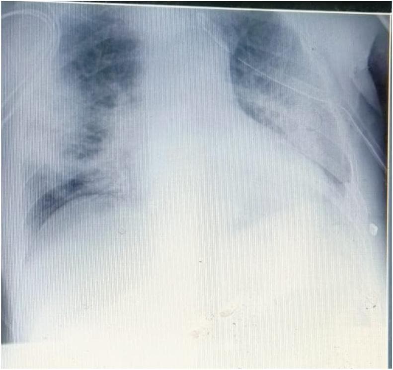 This diagnostic image is an anteroposterior chest X-ray taken following the drainage of a pneumothorax in a patient with COVID-19 pneumonia. The radiograph demonstrates bilateral, diffuse hazy opacities and ground-glass patterns, particularly pronounced in the left lung field, which obscure normal bronchovascular markings and signify extensive parenchymal damage. A chest drainage tube is visible on the right side, consistent with the clinical history of pneumothorax management. The cardiac silhouette is centrally positioned with no evidence of mediastinal shift. The pulmonary findings are characteristic of severe viral pneumonia complications, illustrating typical post-inflammatory changes and the iatrogenic management of gas effusions in a critical care setting.