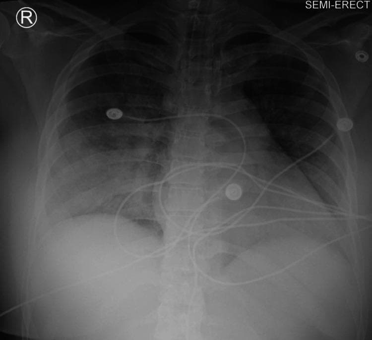 This chest radiograph (X-ray) in a semi-erect position shows diffuse, bilateral, and confluent alveolar opacities consistent with severe pulmonary edema, such as negative-pressure pulmonary edema (NPPE). The opacities are distributed throughout both lung fields, demonstrating a ‘bat-wing’ or ‘butterfly’ pattern typical of acute fluid accumulation. Despite the extensive infiltrates, the cardiac silhouette appears within normal size limits, suggesting a non-cardiogenic etiology for the edema. Several medical devices are visible, including an endotracheal tube (ETT) for airway management and multiple ECG monitoring leads superimposed over the thoracic cavity. Anatomical landmarks including the clavicles, ribs, and diaphragmatic contours are visible but partially obscured by the overlying pulmonary pathology. This diagnostic image serves as an educational example of monitoring the progression and treatment response of acute respiratory distress in a perioperative or intensive care setting.