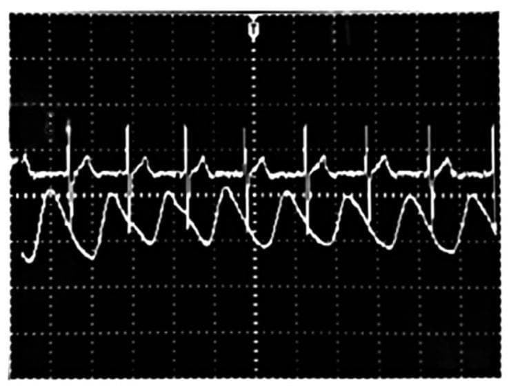 This diagnostic image displays a dual-channel waveform comparison on a gridded oscilloscope-style background, representing physiological monitoring signals. The upper waveform is a standard Electrocardiogram (ECG) trace characterized by distinct, high-frequency R-wave spikes occurring at regular intervals, alongside smaller P and T waves. The lower waveform represents a heartbeat signal acquired via a fiber optic plethysmography system. This lower trace exhibits a larger amplitude with a smoother, sinusoidal morphology and a lower frequency relative to the ECG. The visual comparison demonstrates the temporal correlation between cardiac electrical activity (ECG) and the resulting mechanical pulsatile blood flow (plethysmogram), where each R-wave spike in the upper trace precedes a corresponding peak in the lower pulsatile wave. This visualization is used in biomedical engineering and clinical diagnostics to validate the accuracy of novel physiological sensors against gold-standard monitoring techniques like electrocardiography.