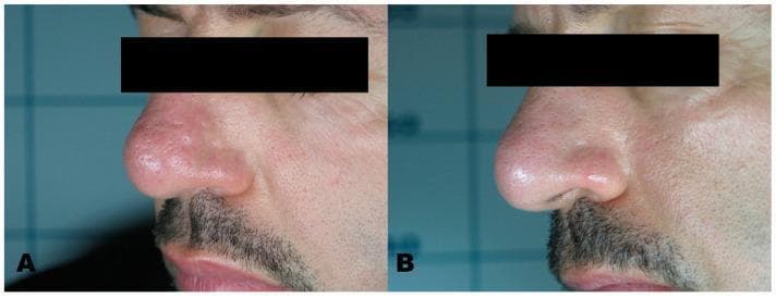 This clinical photograph represents a before-and-after comparison of a patient undergoing dermatological treatment for sebaceous hyperplasia. Panel A shows the lateral view of the nose with numerous small, skin-colored to slightly yellowish, umbilicated papules characteristic of hypertrophic sebaceous glands. The lesions are clustered on the nasal dorsum and tip, creating a cobblestone texture. Panel B demonstrates the same anatomical region following treatment with an Erbium laser. There is a significant clinical improvement, with nearly complete resolution of the papules and restoration of a smooth, uniform skin surface. The after-image shows minimal evidence of scarring or post-inflammatory hyperpigmentation, illustrating the efficacy of laser ablation for benign adnexal tumors. This comparison is useful for teaching medical students and dermatology residents about the clinical presentation of sebaceous hyperplasia and the outcomes of ablative laser therapy in aesthetic medicine.