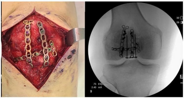 This composite figure illustrates the surgical management of a complex, comminuted patellar fracture (AO/OTA 34-C3). The left image is an intraoperative clinical photograph showing an open reduction and internal fixation (ORIF) procedure. Two parallel longitudinal 2.4 mm locking compression miniplates are positioned anteriorly, joined by a transverse plate to create a stable framework across the fracture fragments. Multiple color-coded locking screws are visible, securing the low-profile plates to the patellar bone. The right image is a corresponding anteroposterior (AP) fluoroscopic radiograph. It demonstrates the radiopaque hardware, including the miniplate construct and several long cannulated or locking screws, bridging the multi-fragmentary fracture lines. The radiographic view confirms the anatomical reduction of the patella and the multidirectional stabilization provided by the variable-angle locking system. This technique is typically employed for highly comminuted fractures where traditional tension band wiring may be insufficient for rigid fixation and early mobilization.