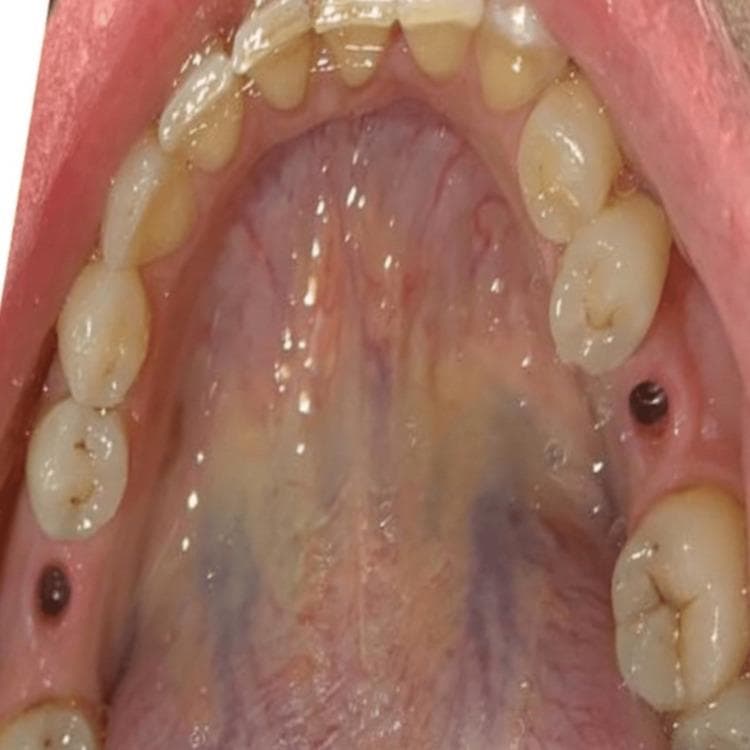 This intraoral clinical photograph provides an occlusal view of the maxillary arch, focusing on the soft tissue healing following dental implant surgery. The image demonstrates the emergence profile of the gingiva in the second surgical stage. Two circular, dark-colored healing abutments are visible protruding from the alveolar ridge at edentulous sites, surrounded by healthy, pink, well-contoured keratinized mucosa. The hard palate shows typical anatomical features, including rugae and a midline raphe, with normal vascular variations and a moist surface. The adjacent natural dentition shows light yellowish coloration with evidence of minor incisal wear and fair oral hygiene, characterized by slight marginal gingival erythema indicative of mild gingivitis. This image is used to illustrate the peri-implant soft tissue management and the establishment of an appropriate gingival emergence profile required before the final prosthetic restoration with zirconia crowns.