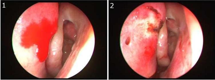 This clinical image consists of two side-by-side endoscopic views of the left nasal cavity, illustrating the identification and management of posterior epistaxis at the S-point. View 1 (left) shows active arterial bleeding with bright red blood pooling on the superior portion of the nasal septum, located above the axilla of the middle turbinate. This specific anatomical site, known as Stamm's S-point, is associated with vascular supply from the anterior ethmoidal artery (AEA). View 2 (right) demonstrates the same anatomical region post-intervention. The active hemorrhage has ceased following localized cauterization, characterized by a visible area of dark, charred tissue and mucosal erythema at the previous bleeding site. This comparison highlights a critical diagnostic location for non-anterior epistaxis and the efficacy of targeted endoscopic cautery. The material is intended for advanced medical education in otorhinolaryngology, focusing on the management of severe nasal hemorrhage.