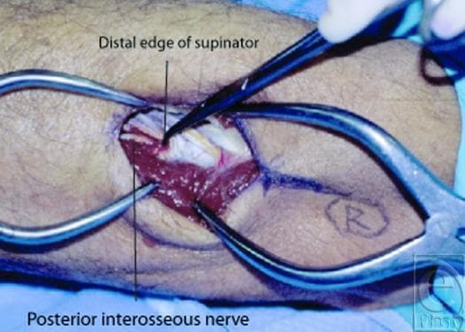 Clinical photograph showing a surgical dissection of the posterior forearm to demonstrate anatomical landmarks relevant to radial nerve compression. The image features a vertical incision retracted by metallic surgical instruments to reveal deep musculoskeletal structures. The supinator muscle is visible as a dark red, striated tissue mass in the center of the field. A black pointer identifies the 'Distal edge of supinator,' which exhibits a whitish-yellow, fibrous texture. Deep to this fibrous margin, the posterior interosseous nerve (PIN) is identified as it exits the supinator muscle. This anatomical view is critical for understanding surgical decompression sites for radial tunnel syndrome and PIN syndrome, highlighting the relationship between the distal supinator fascia and the exiting motor branch of the radial nerve.