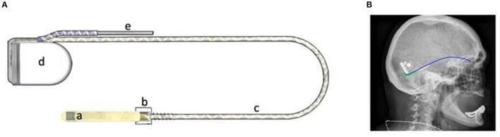 This educational graphic illustrates the components and surgical placement of the Retina Implant Alpha AMS, a subretinal visual prosthesis. Figure A is a schematic diagram showing the device's hardware: (a) a distal polyimide foil containing the CMOS microchip with 1,600 pixel cells for subretinal stimulation; (b) a scleral patch on a ceramic chip for trans-scleral anchoring; (c) a flexible, looped silicone power cable; (d) a retroauricular subdermal ceramic housing containing inductive coupling coils for transdermal power; and (e) a return electrode. Figure B is a lateral skull radiograph demonstrating the clinical positioning of the implant. The radiopaque silicone power cable is seen routed along the skull's curvature beneath the temporal muscle, connecting the orbital implant site to the ceramic housing and return electrode located in the temporal/retroauricular region. This visual highlights the integration of microelectronics with surgical anatomy for restoring vision in patients with outer retinal degeneration, such as retinitis pigmentosa.