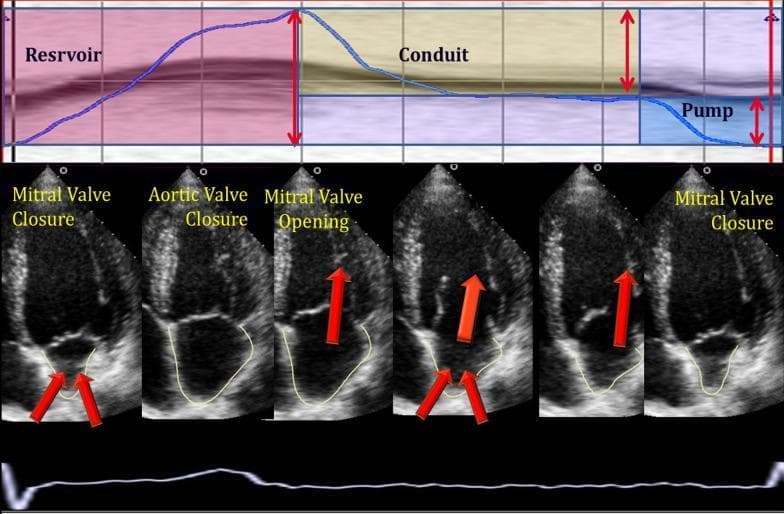 This medical illustration combines a physiological graph and echocardiographic frames to depict left atrial (LA) phasic function during the cardiac cycle. The top panel presents a color-coded volume-over-time curve divided into three functional phases: Reservoir (pink), representing LA filling during ventricular systole; Conduit (tan), showing early passive LA emptying after mitral valve opening; and Pump (blue), indicating active atrial contraction during late diastole. Vertical red arrows quantify volume changes for each phase. The middle panel features six apical four-chamber view echocardiograms with manual endocardial tracing (yellow outlines) of the LA. These frames are synchronized to clinical events: mitral valve closure (minimum LA volume), aortic valve closure (maximum LA volume), and mitral valve opening. Red arrows on the ultrasound images highlight the status of the mitral and aortic valves. The bottom panel displays a synchronized electrocardiogram (ECG) trace. This educational visual demonstrates how automated Vector Velocity Imaging (VVI) software tracks atrial mechanics and volumes to assess diastolic function in patients.