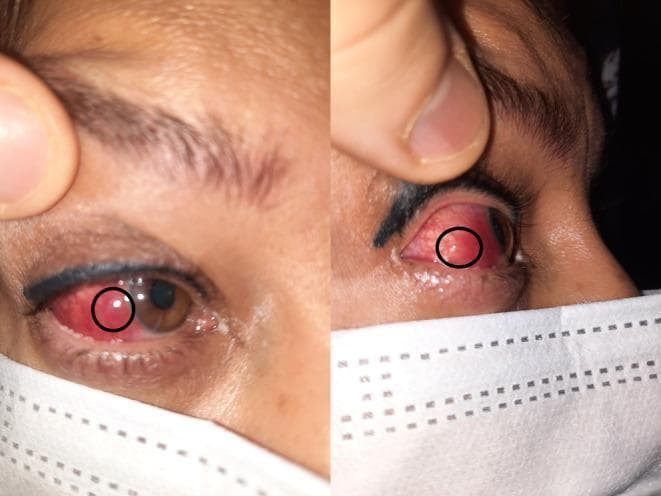 Content Type: Clinical Photograph. This composite image shows two views of a patient's right eye, highlighting inflammatory ocular signs. The left panel shows a frontal view of the eye with significant violaceous (purplish) scleral hyperemia and a distinct, circumscribed nodule (circled) on the temporal sclera. The right panel provides a lateral view, further illustrating the elevation and localized nature of the nodular lesion against the hyperemic scleral background. The purplish hue is characteristic of deep episcleral or scleral vessel involvement, often seen in scleritis. The iris appears brown and the cornea remains clear in these views. The images demonstrate the clinical presentation of nodular scleritis, an inflammatory condition of the eye's outer protective layer. These findings are pedagogically useful for distinguishing between superficial episcleritis (which typically presents with a brighter red hue) and deeper scleral inflammation (which exhibits a darker, violaceous color).