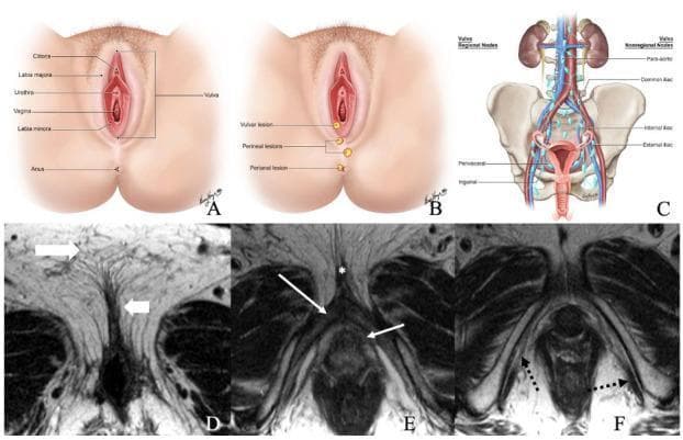 A multi-panel educational figure illustrating the normal anatomy of the female vulvar region and its lymphatic drainage. Panels A and B are anatomical illustrations showing external structures including the clitoris, labia majora and minora, urethra, vagina, and anus, with markers for typical lesion locations. Panel C is a schematic diagram of the lymphatic system, detailing regional (inguinal, perivisceral) and non-regional (external iliac, internal iliac, common iliac, and para-aortic) lymph nodes relative to the pelvis and kidneys. Panels D–F present axial non-fat saturated T2-weighted MRI scans of a 36-year-old female. Image D identifies the labia majora and labia minora through their signal intensities. Image E highlights the deep structures including the bulb of the vestibule, glans clitoris, and crus of the clitoris. Image F demonstrates the ischiocavernosus muscle. This content provides foundational anatomical context for the staging and clinical evaluation of vulvar cancer.